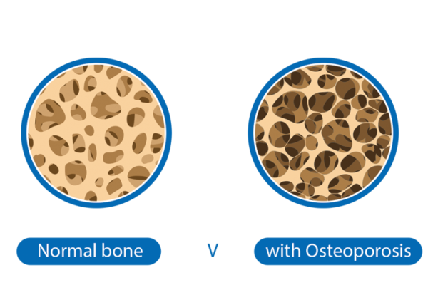 Osteogenesis Imperfecta - Irish Osteoporosis Society